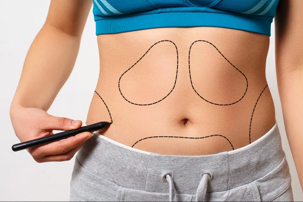 Liposuction Surgery in Bengaluru for Targeted Fat Reduction Solutions