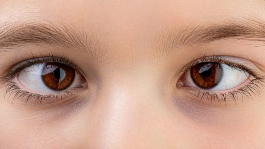 Squint Correction and Eye Alignment Treatment in Charni Road – Restoring Balanced Vision