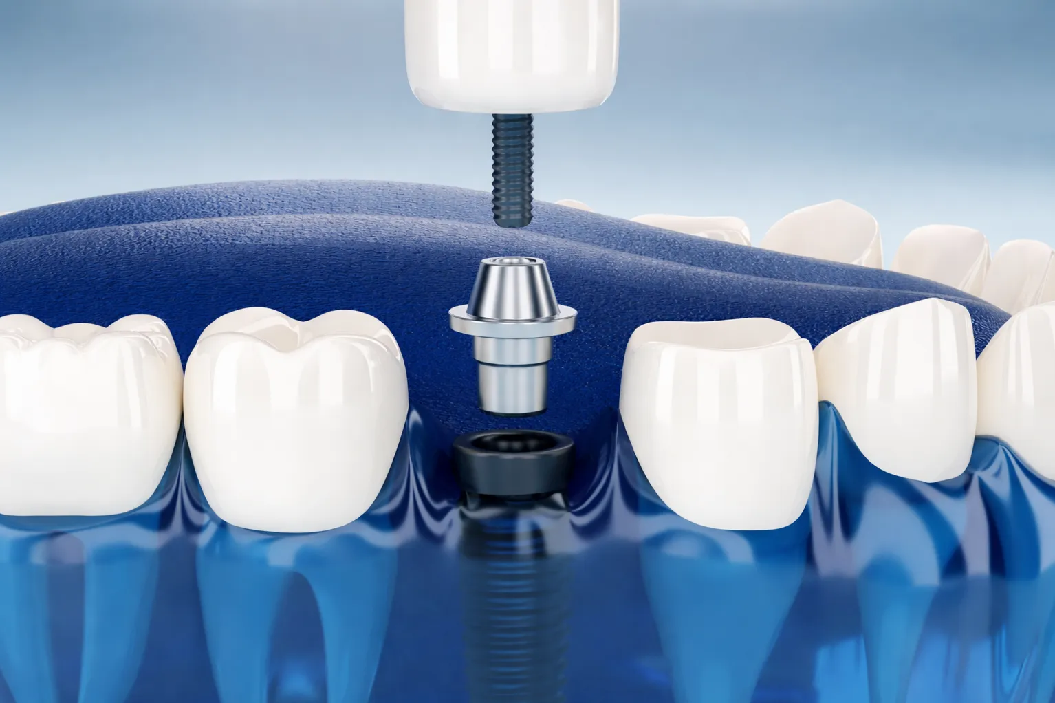 Dental Implants in Munnireddypalya - Restoring Chewing Function and Smile Confidence