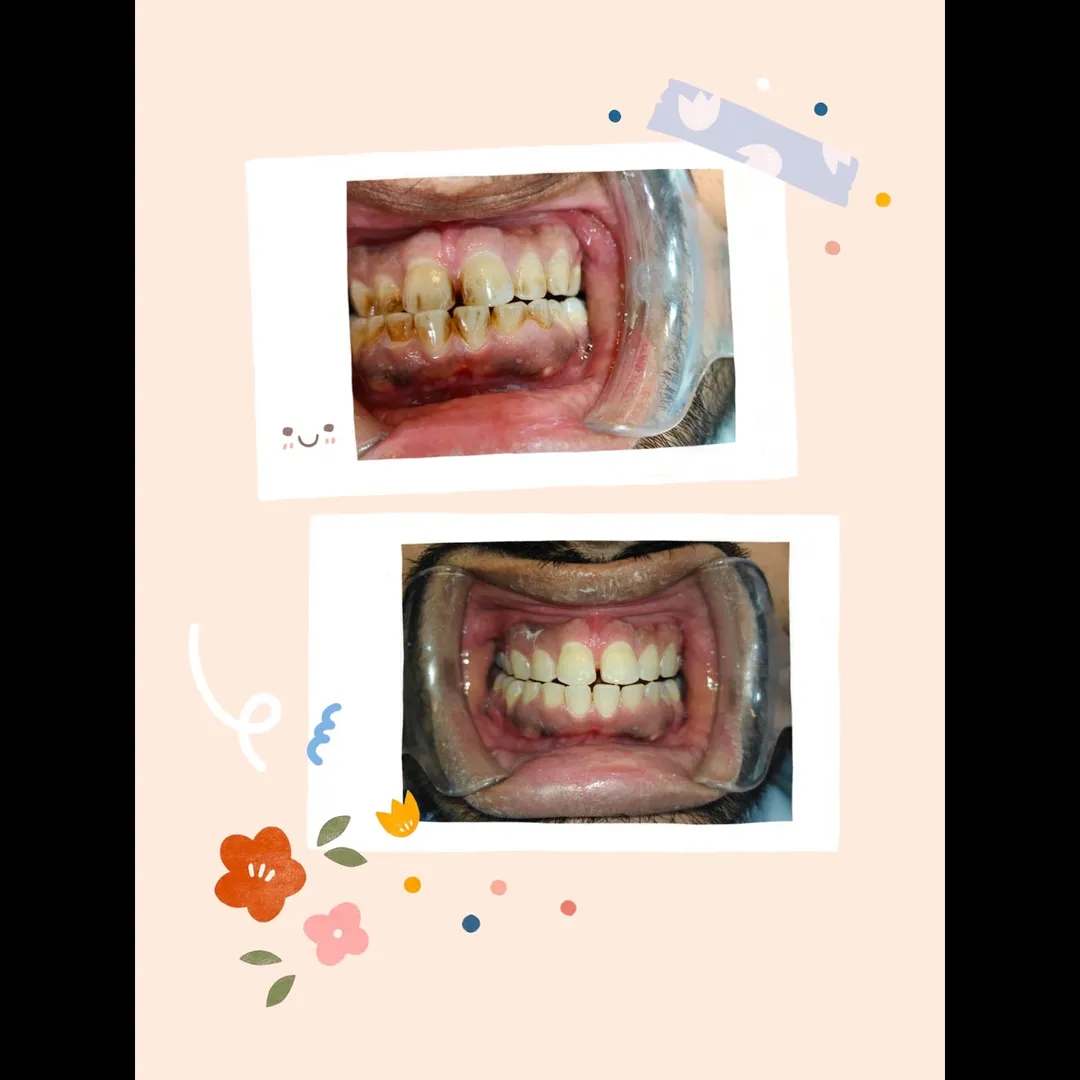 Teeth Cleaning & Fillings in Gaur City | P.D. Dental Clinic