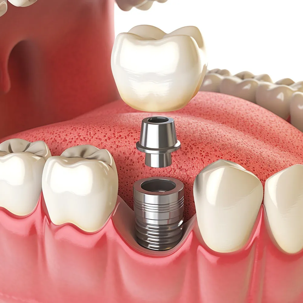 Full Mouth Dental Implants Specialist in Dwarka When One Solution Changes Everything