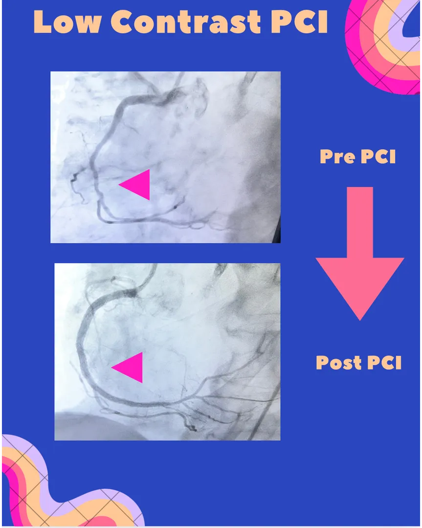 đź«€ Heart Procedure with Minimal Dye: A Safer Approach for Kidney Patients in Navi Mumbai