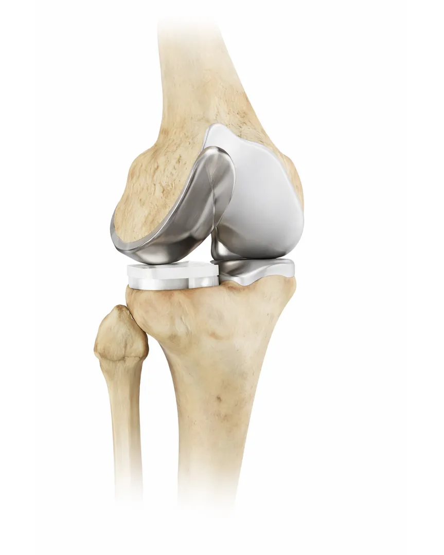 Partial Knee Replacement Surgery in Wadala - Targeted Relief with Joint Preservation