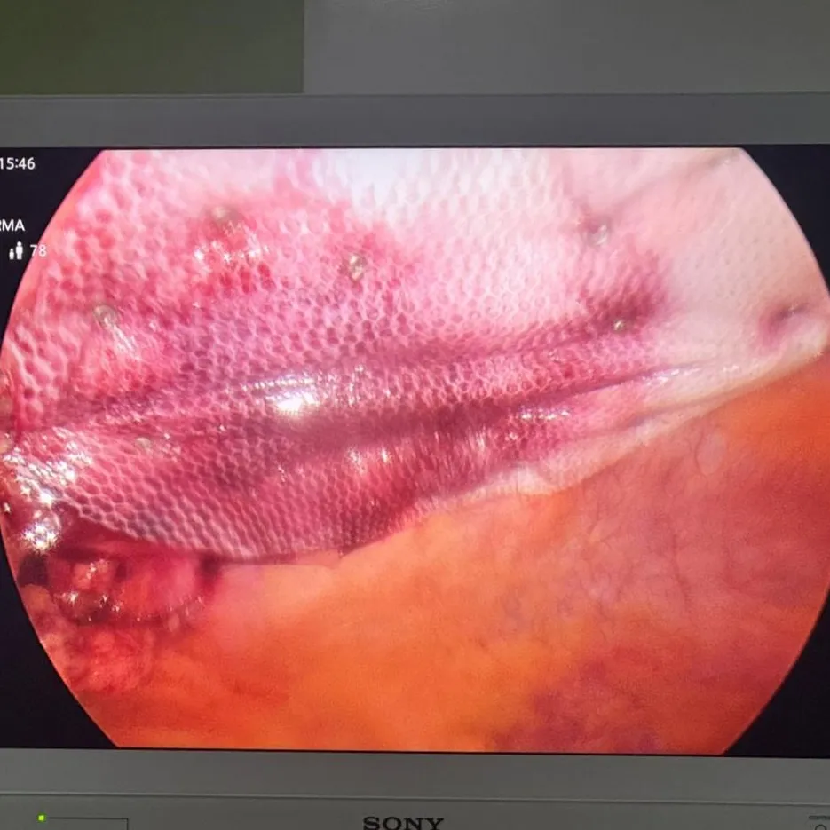 Ventral Hernia