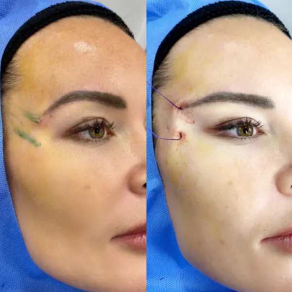 Thread Lift Surgery in Andheri West, Juhu & Lokhandwala | Non-Surgical Face Lift in Mumbai