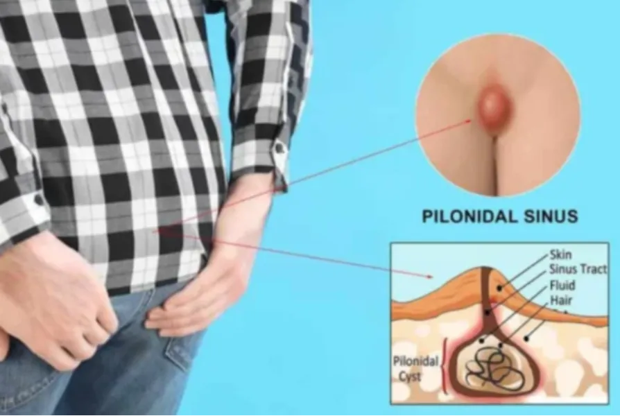 Laser Treatment for Pilonidal Sinus in Worli – Advanced Treatment for Chronic Sinus Infection