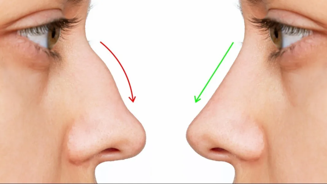 Rhinoplasty Surgery in Bengaluru for Balanced Facial Harmony