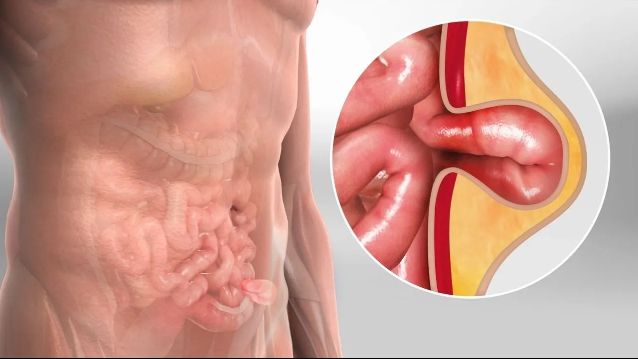 Hernia Surgeon in Kolathur, Chennai - Advanced Treatment for Lasting Relief