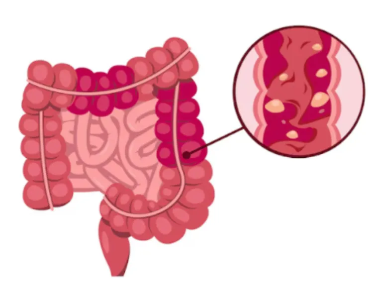 Inflammatory Bowel Disease IBD in Mumbai Understanding Long Term Gut Health Challenges
