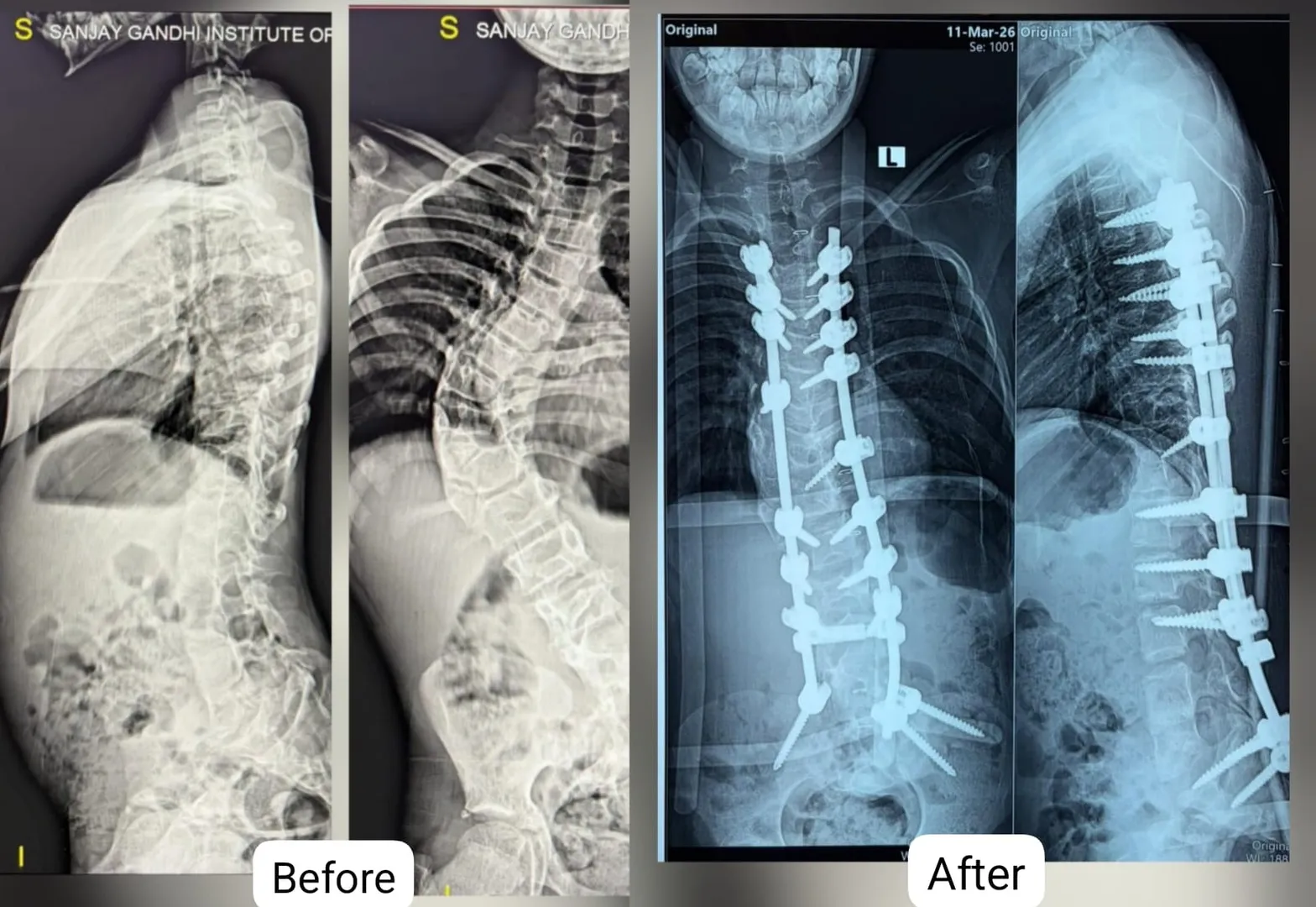 Spinal Deformity Correction Surgery in Jayanagar Bangalore
