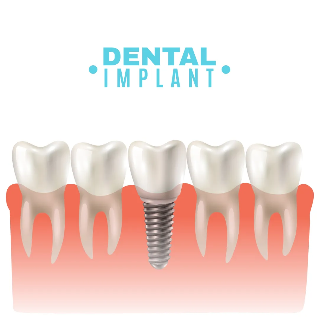 Dental Implants in Nashik – The Modern Solution for Missing Teeth