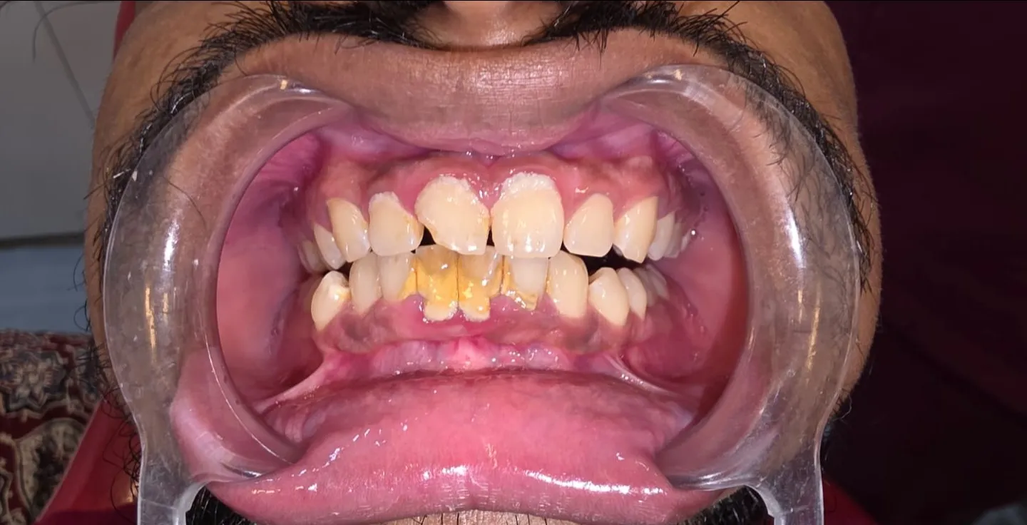 How Long Does Gum Treatment Take? Timeline Explained by Dentists in Mulund West Mumbai
