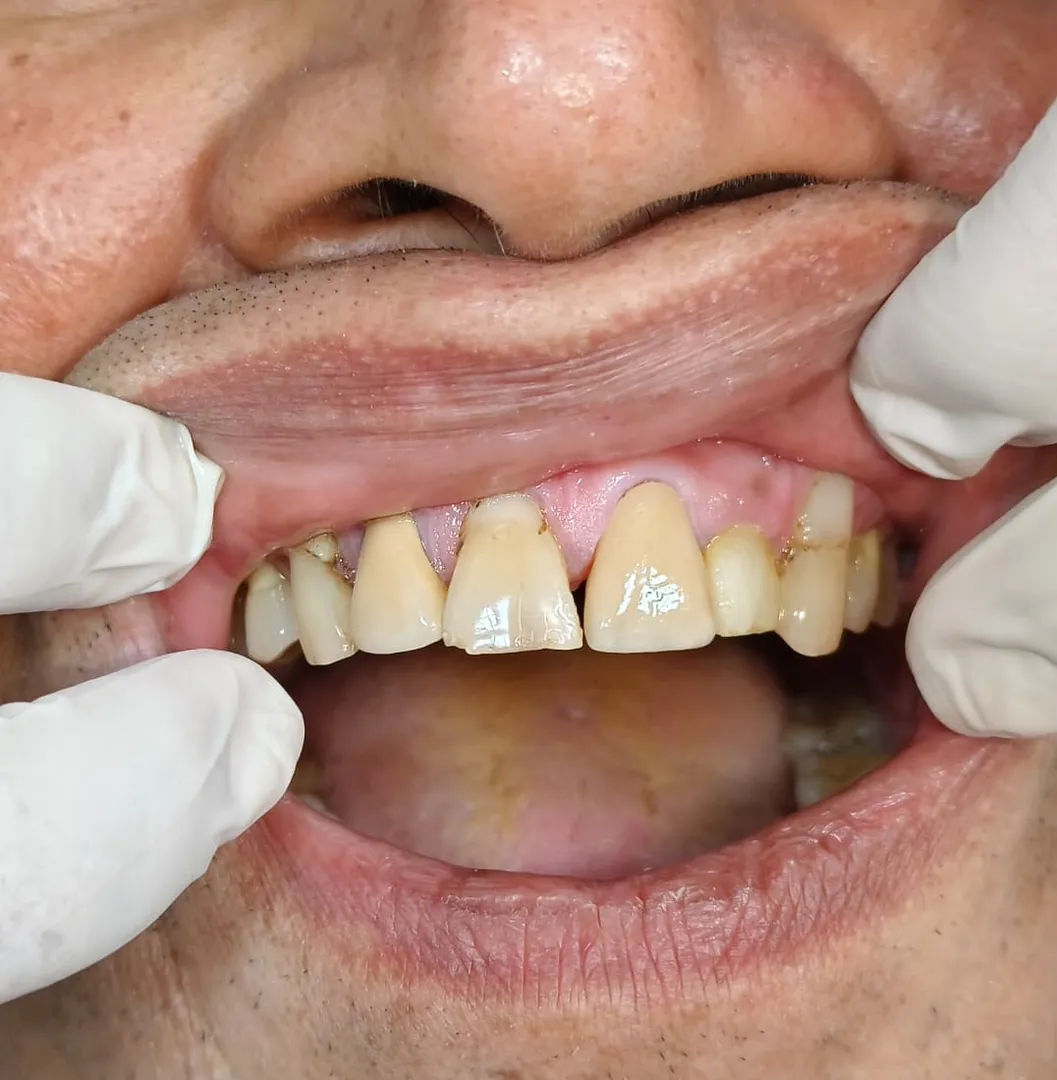 How Much Does Dental Crowns Cost in Thane (Nitin Company Area)? A Complete Patient Guide