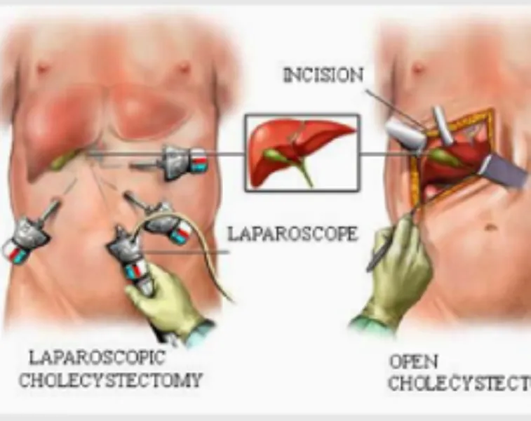 Laparoscopic Cholecystectomy Surgery in Thane – Safe Gallbladder Removal with Faster Recovery