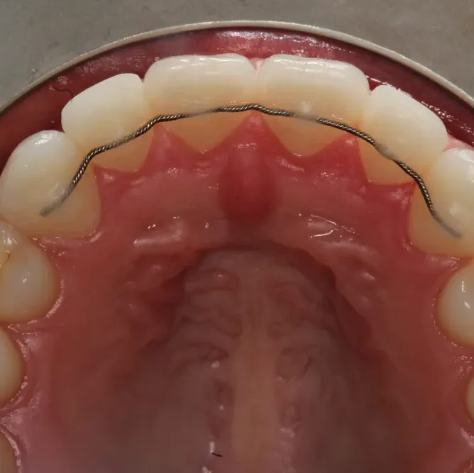 How to Take Care of Your Retainer After Braces Treatment? By Align and Smile Dental Care, Sector 18