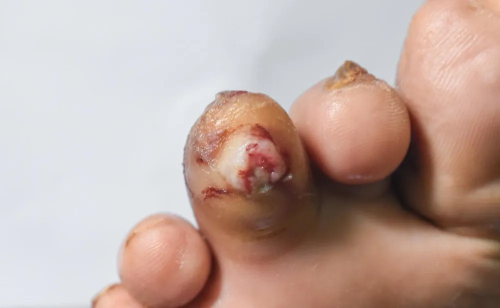 Foot Ulcer Treatment for Diabetes in Seawoods Preventing Small Wounds from Becoming Serious