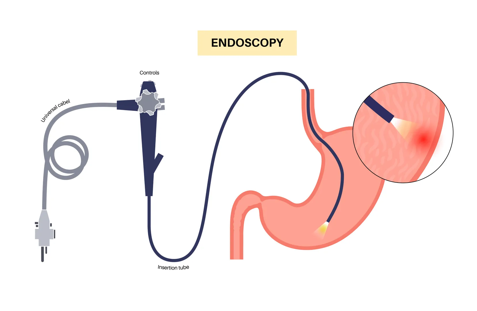 Upper GI Endoscopy Procedure in South Mumbai A Clear View into Digestive Health