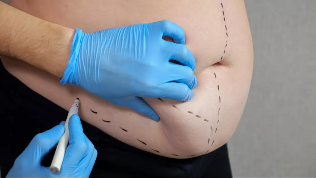 Tummy Tuck Surgery in Bengaluru for a Firm and Defined Abdomen