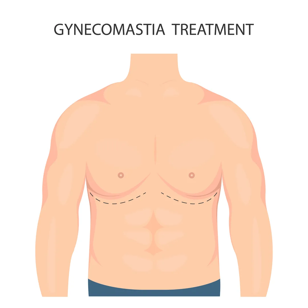Gynecomastia Treatment in Bengaluru for Male Chest Contouring