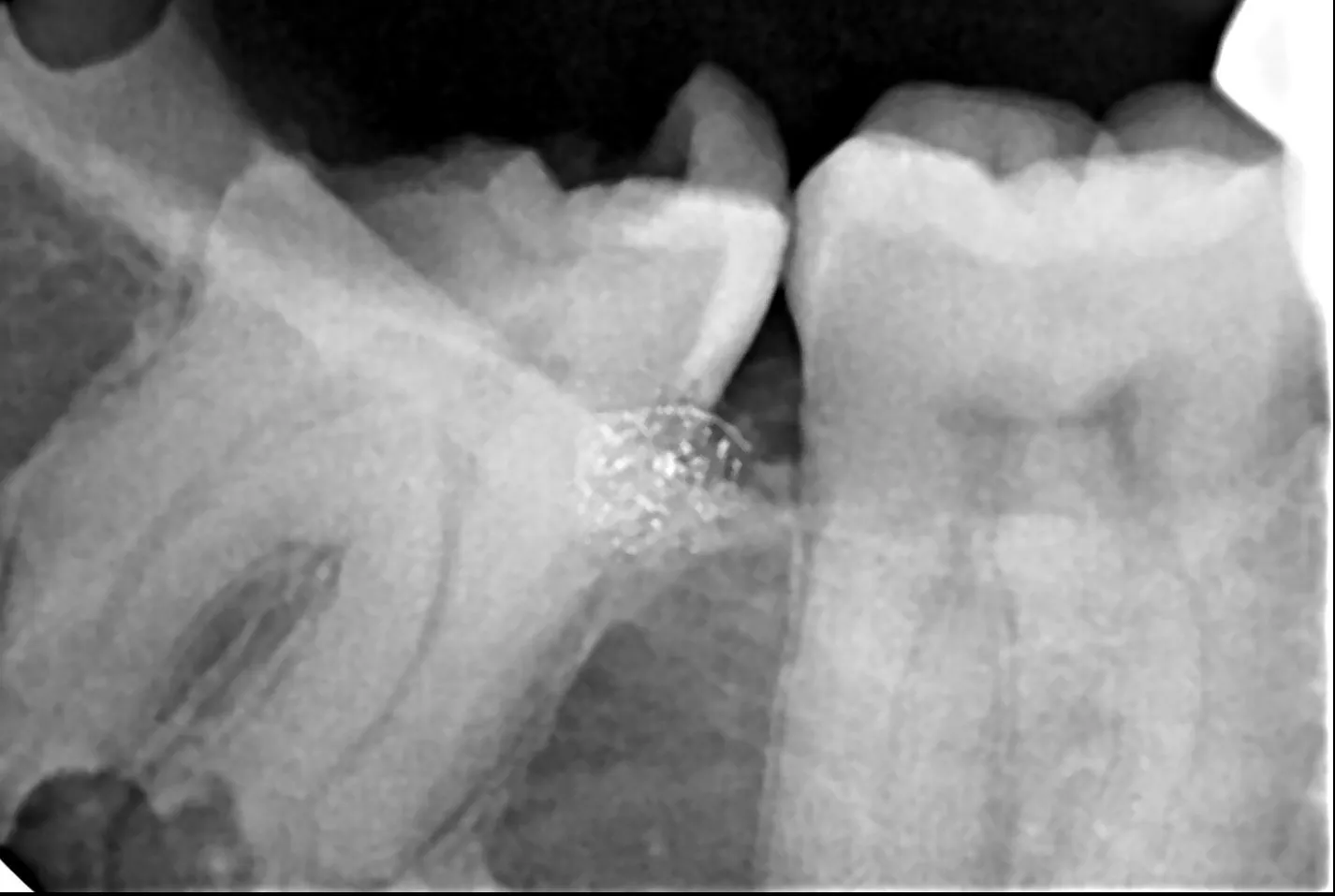 Looking for Wisdom Tooth Removal Near Me? What Patients in Thane (Nitin Company Area) Should Know