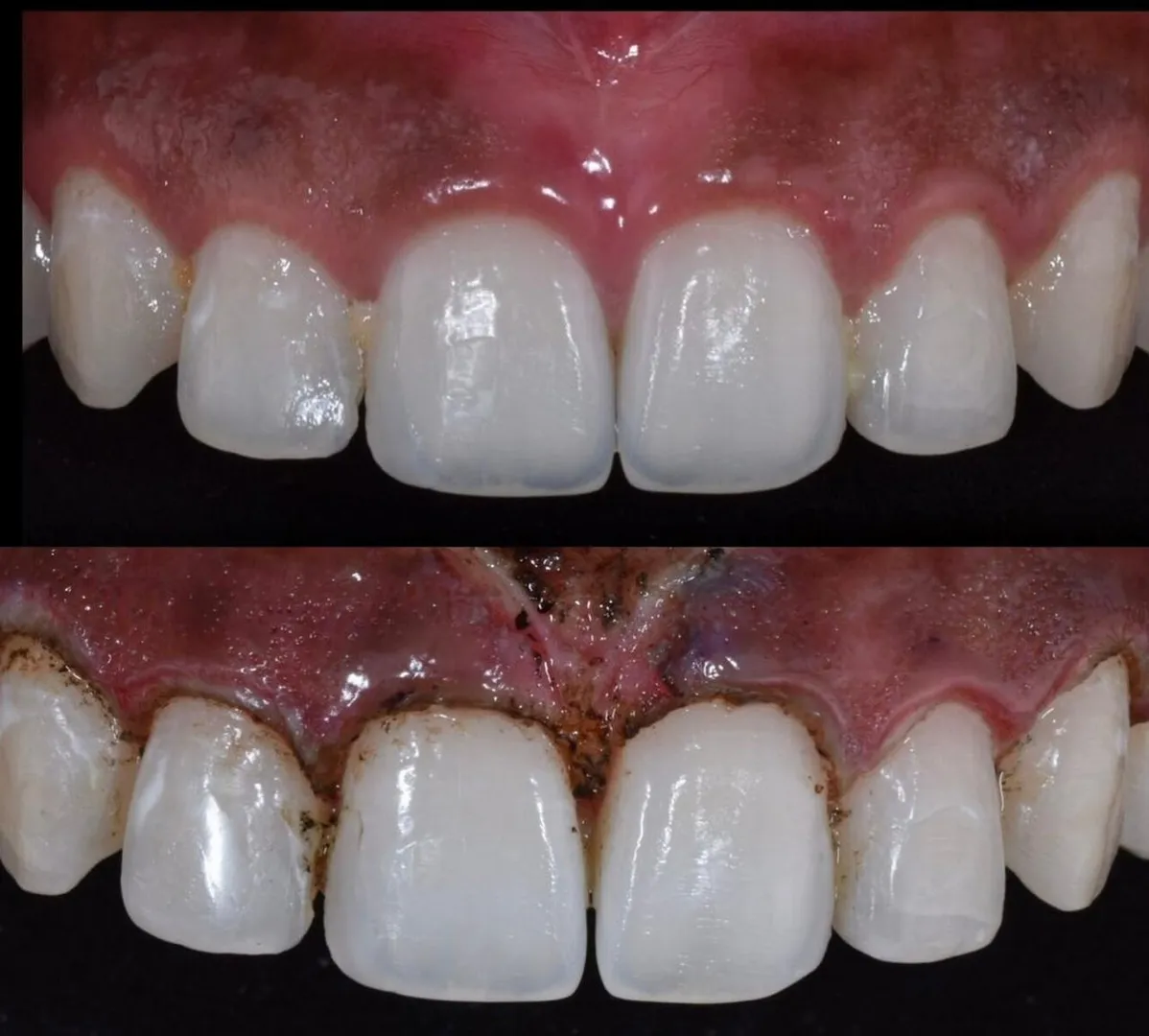 How Long Does Laser Dentistry Take? Timeline Explained by Dentists in Thane (Nitin Company Area)