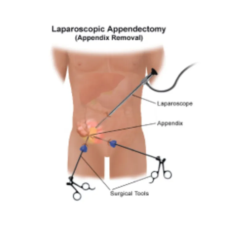 Laparoscopic Appendectomy Surgery in Thane – Quick Relief for Appendix Pain
