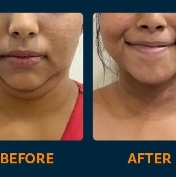 Double chin reduction treatment In Vashi
