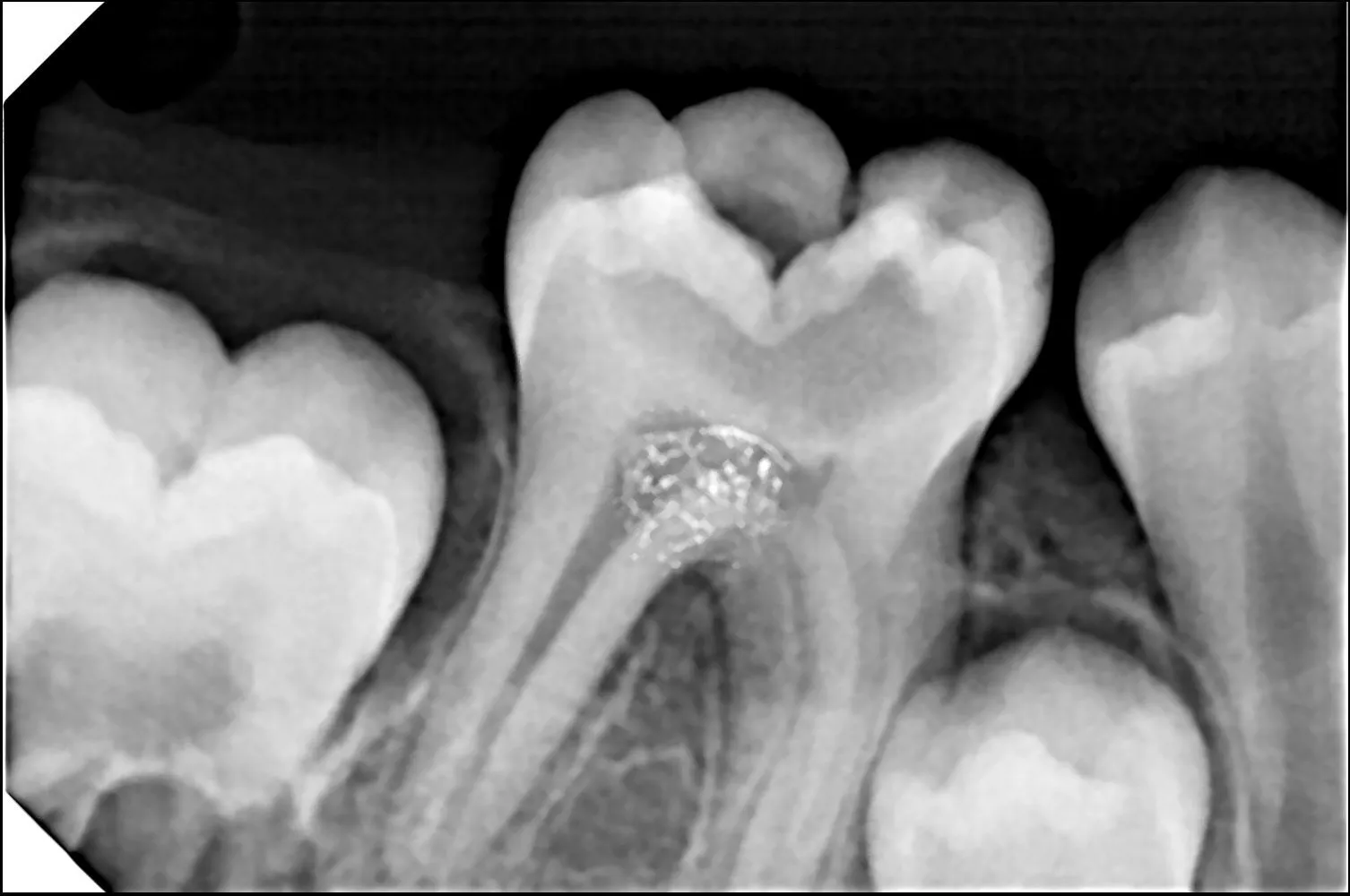 How Much Does Root Canal Treatment Cost in Thane (Nitin Company Area)? A Complete Patient Guide