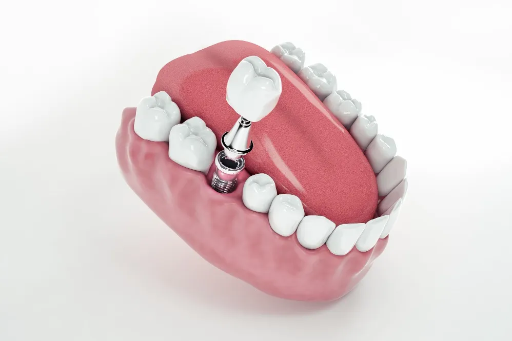 Dental Implants in Munnireddypalya for a Strong and Lasting Tooth Replacement