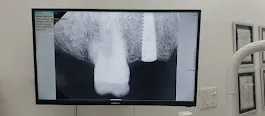 How Long Do Dental Implants Last? | Align & Smile Dental Care, Sector 18 Noida