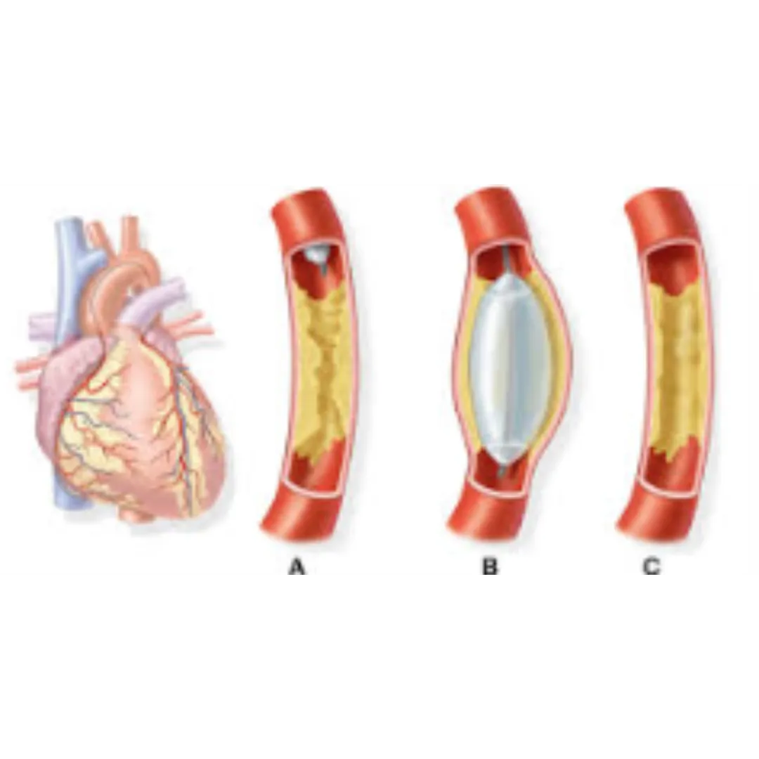 Angiography in Pune for Accurate Heart Diagnosis