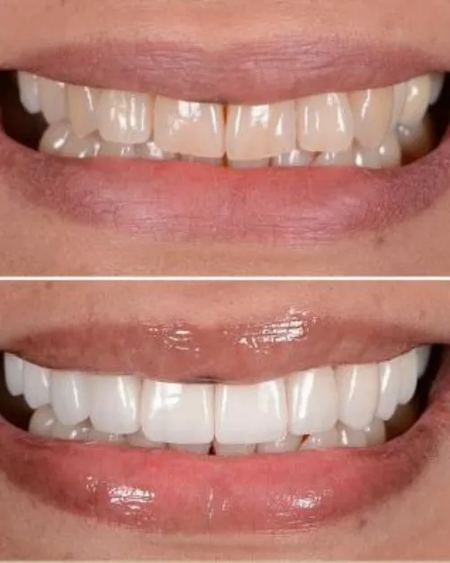 How Long Does Dental Veneers Take? Timeline Explained by Dentists in Thane (Nitin Company Area)
