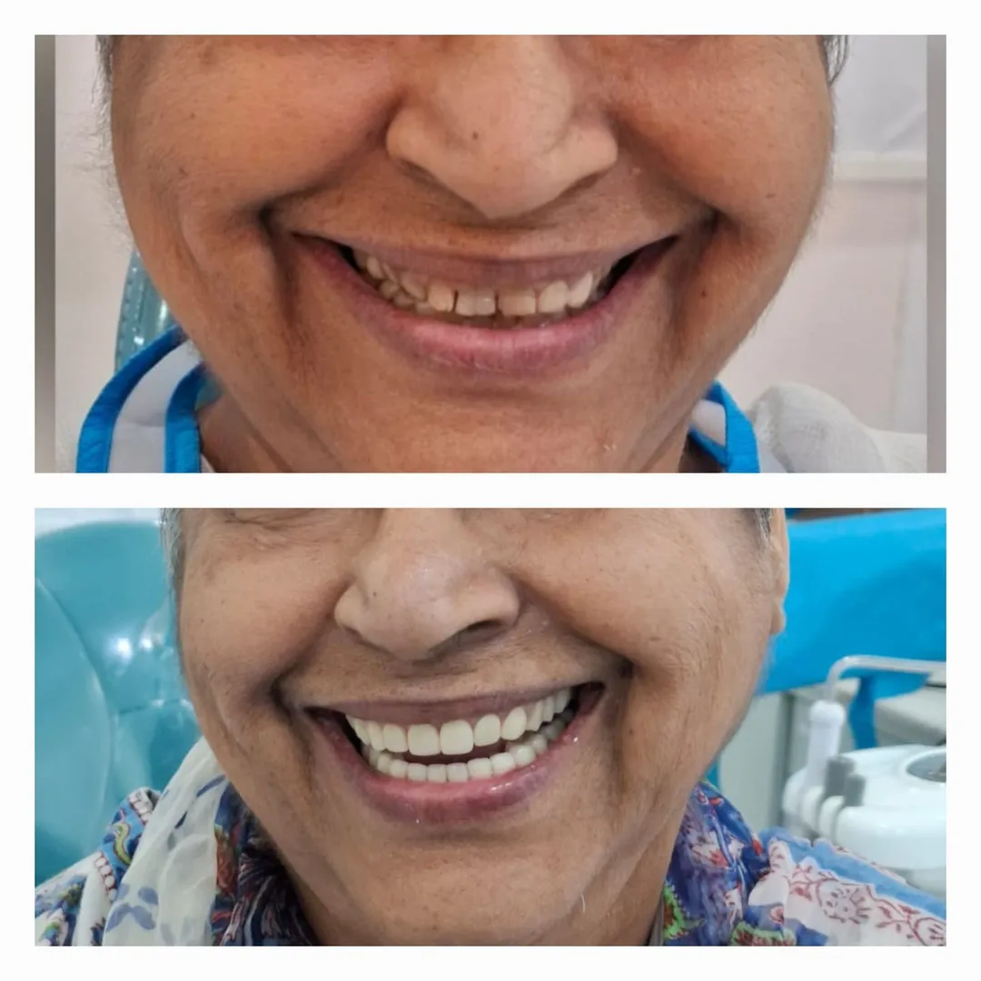 Full Mouth Rehabilitation (FMR)