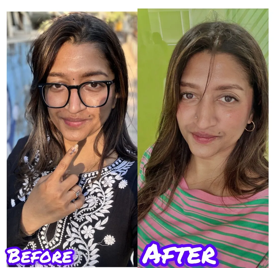Dr.Pen Treatment In Vashi
