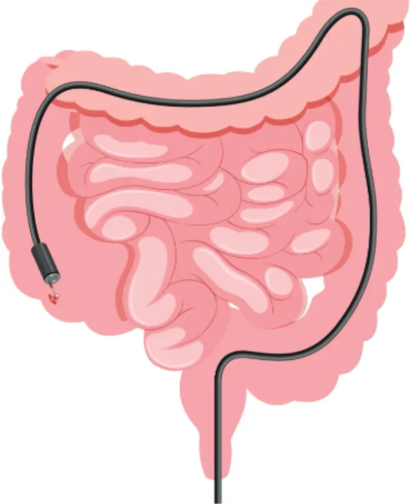 Colonoscopy Diagnostic Procedure in Byculla Early Detection for Colon Health