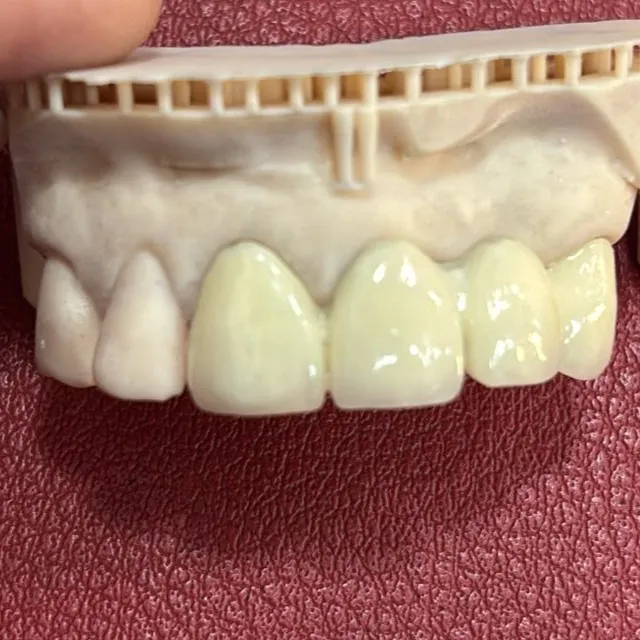 Dental Crowns in Thane (Nitin Company Area): Before, During & After Treatment Guide