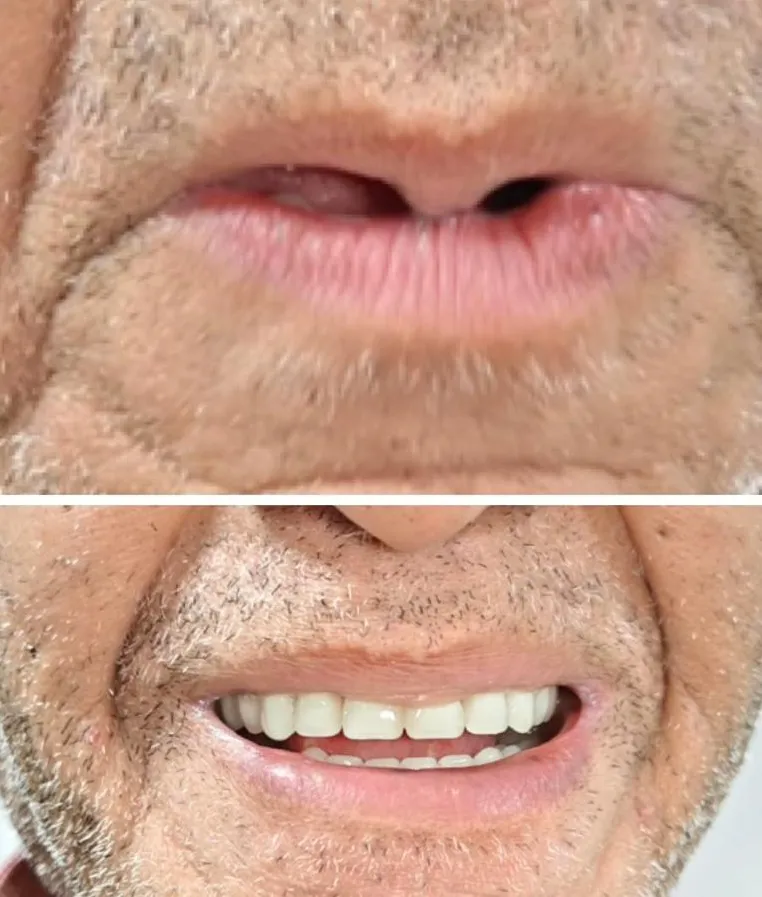 Is Smile Makeover Painful? Dentist in Mulund West Mumbai Explains the Truth