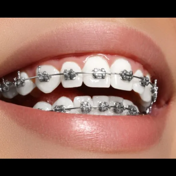 Braces Treatment In Vashi