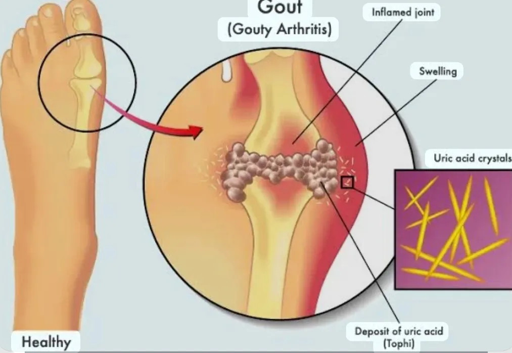About Uric Acid Information in Near Chhatrpati Shivaji Maharaj Hospital Kalwa