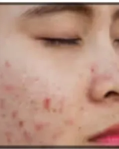 Skin Problem Best Solution in Kalwa west Thane