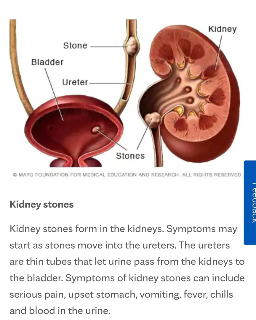 Kidney Stone Treetment Via Natural Contact Kalwa west
