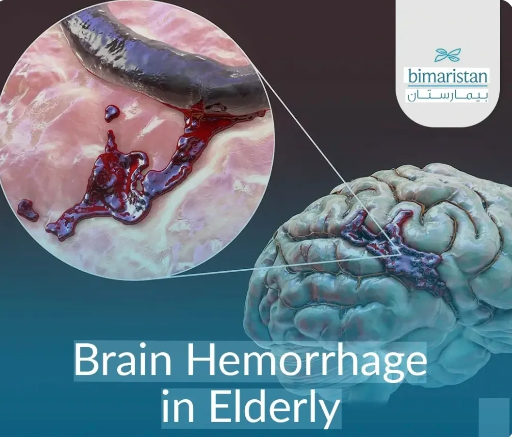 Brain Hemorrage More effective Information in chattapati Shivaji Maharaj Hospital Kalwa west