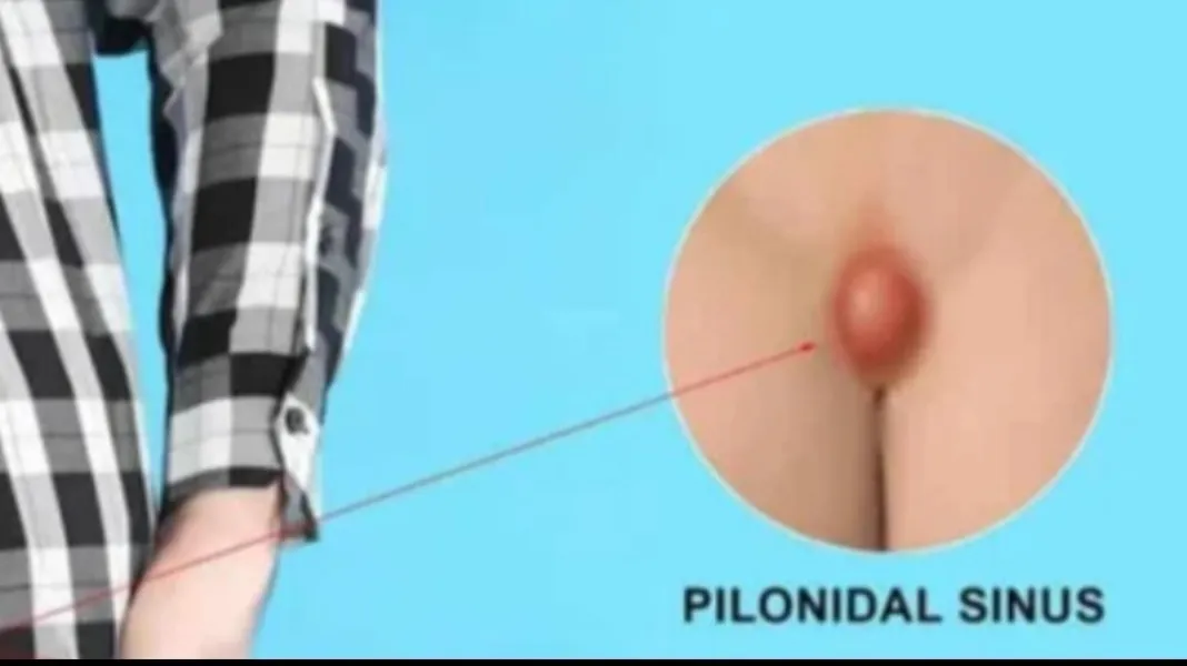 Pilonidal Sinus Laser Surgery Expert in Andheri East Offering Targeted Treatment Options