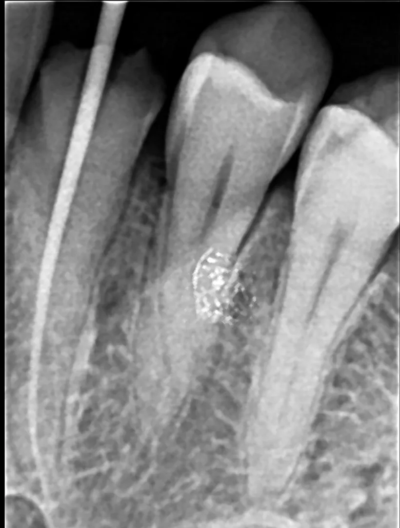 Root Canal Treatment in Mulund West Mumbai: Before, During & After Treatment Guide