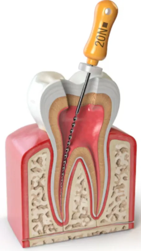 Painless Root Canal Treatment in Dwarka Changing How Dental Care Feels