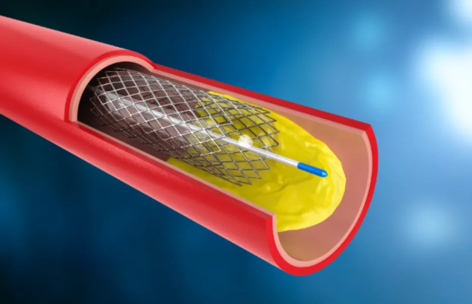 Angioplasty in Pune for Restoring Healthy Blood Flow