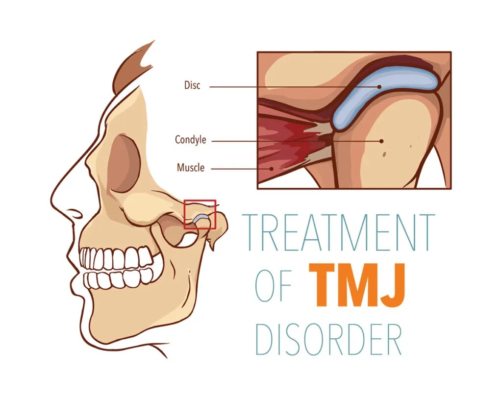 TMJ Treatment & Bite Correction in Gaur City | P.D. Dental Clinic