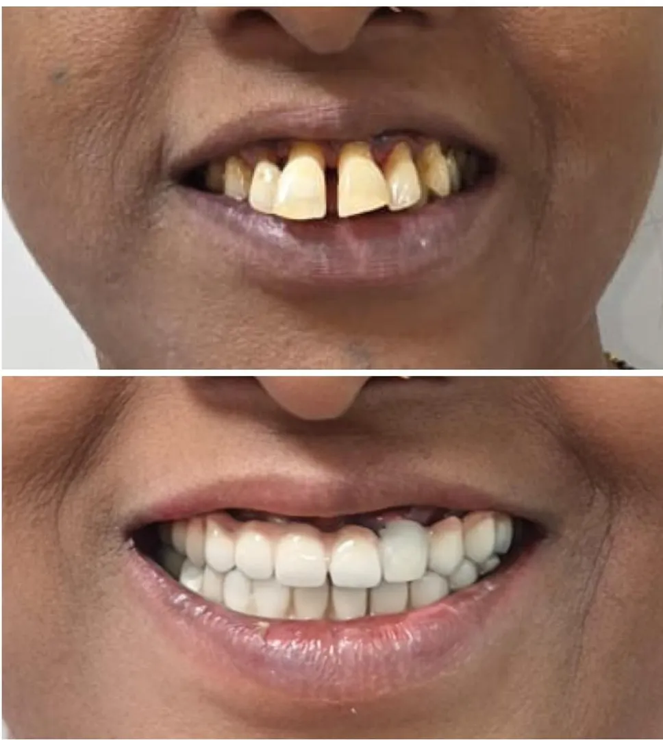 How Much Does Full Mouth Rehabilitation Cost in Thane (Nitin Company Area)? A Complete Patient Guide