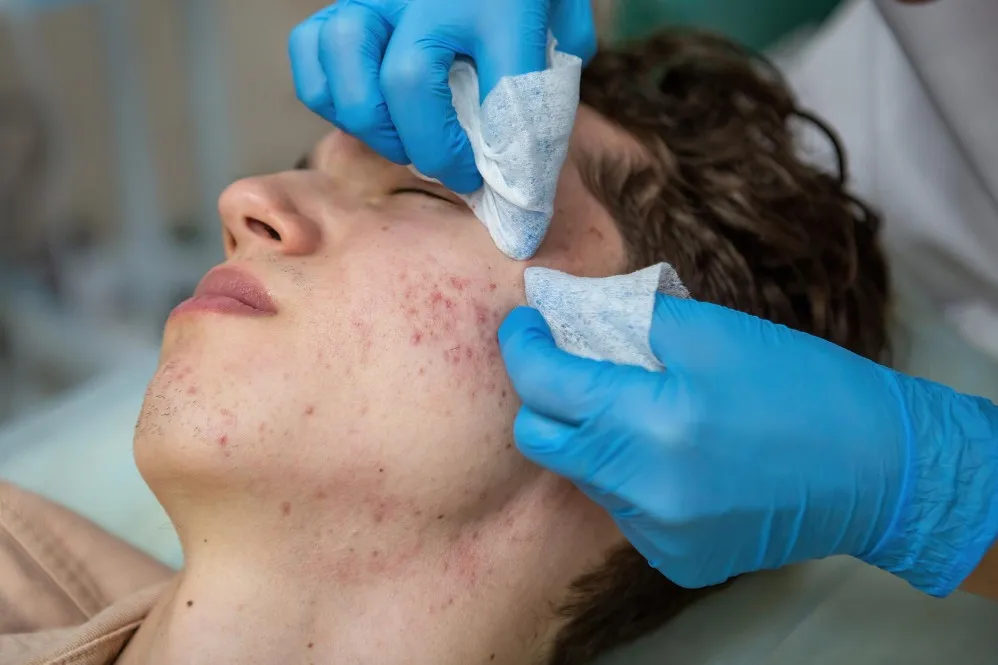 Acne Arrestor Facial in Netaji Subhash Place – Calming Breakouts With Care