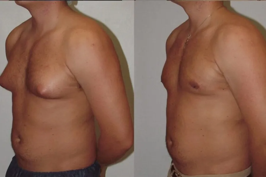 Gynecomastia Surgery in Kolathur, Chennai – A Step Towards Personal Confidence